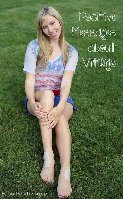 Positive Messages about Vitiligo